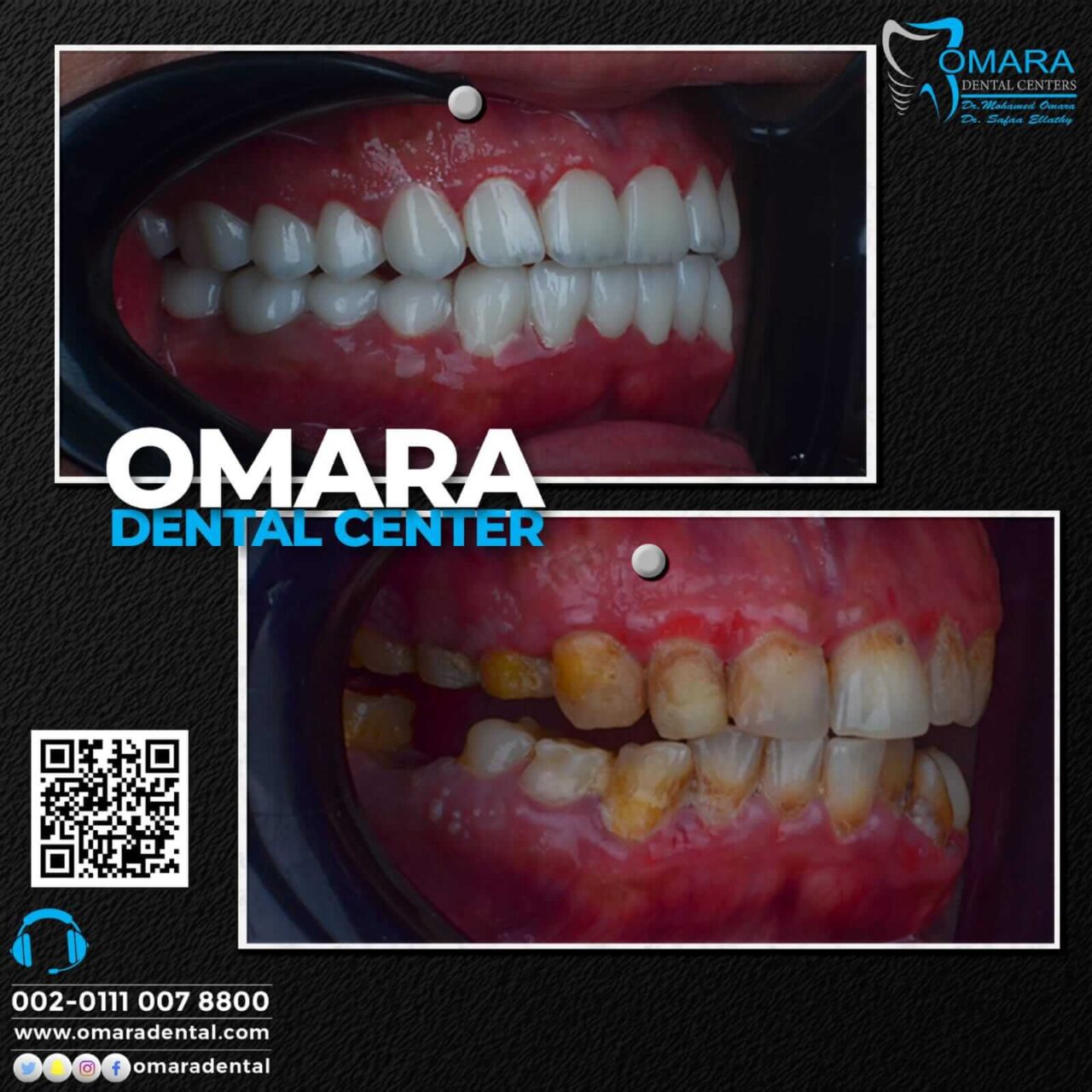 حالات تم علاجها اسنان قبل وبعد فى مراكز الدكتور محمد عمارة لطب الاسنان Some cases of Omara dental centers , Alcuni casi (8)